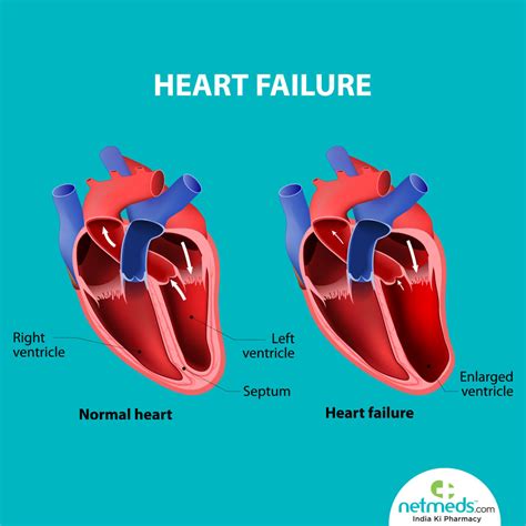 mild lv dysfunction means|mild Lv dysfunction meaning.